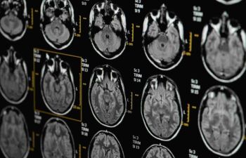 Getty Images-1291540490-MRI-head-imaging-resized