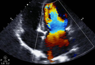 NPS-Medicine Wise-Heart-failure-Webinar-Hero-getty-471488578