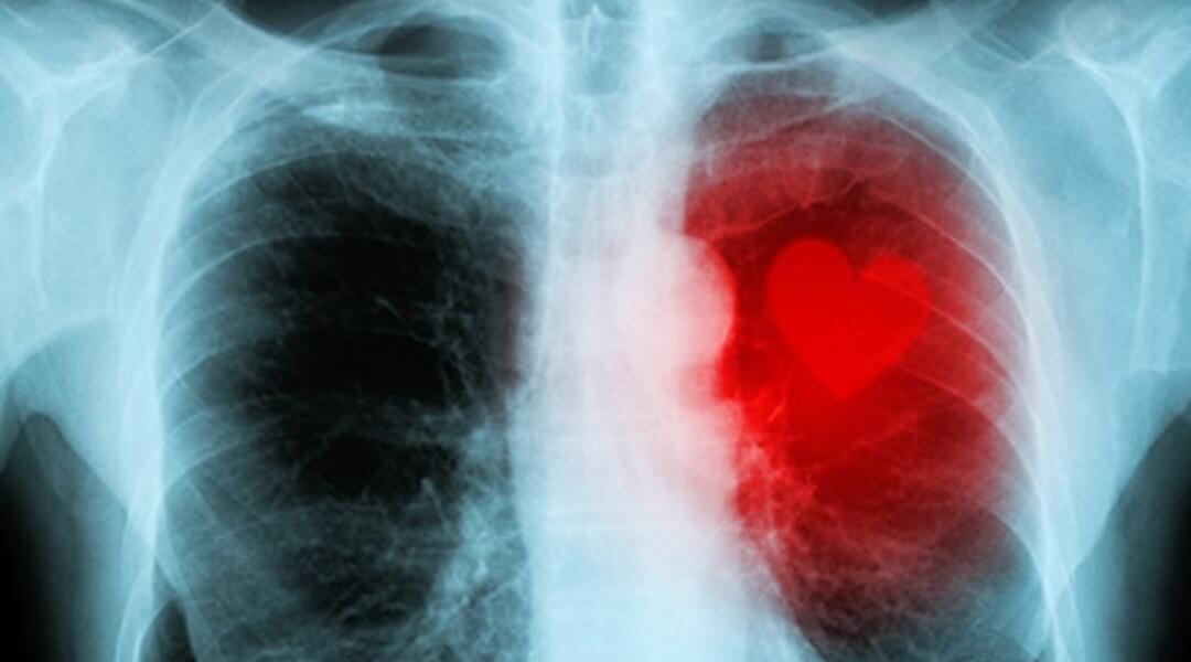 4816E29Cd2449C86 63B2Bc06Fbdc Chronic Heart Failure 440