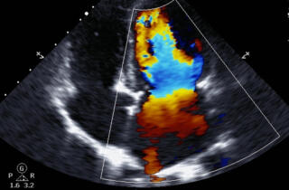 NPS-Medicine Wise-Heart-failure-Webinar-Hero-getty-471488578