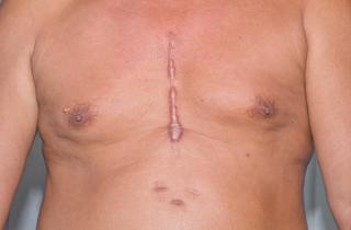 How to manage warfarin therapy