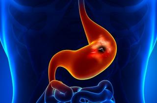 0Cea7Bb9Eb6590E6 F5Ed2D3Db55D Peptic Ulcer 440