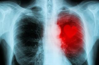 4816E29Cd2449C86 63B2Bc06Fbdc Chronic Heart Failure 440