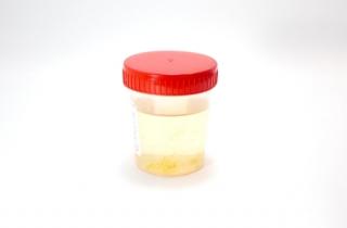 Urinary tract infections